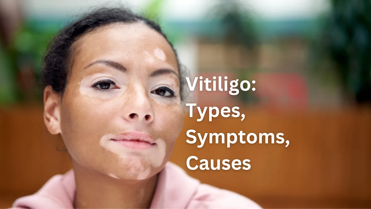 Vitiligo: Types, Symptoms, Causes, Psychological Impact - Dolphin IBA