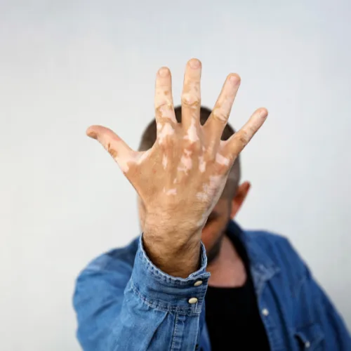 vitiligo pictures hand