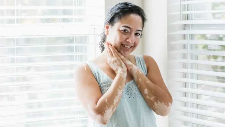 healing vitiligo